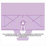 LAVH SURGICAL DRAPE 124INX125IN ABDOMINAL FENESTRATION 7INX9INX9IN/PERINEAL FENESTRATION 3INX6IN ADHESIVE REINFORCED
